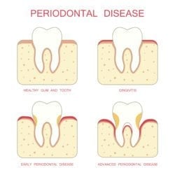 gum disease treatment viera fl