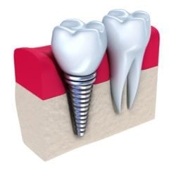 dental implants viera fl