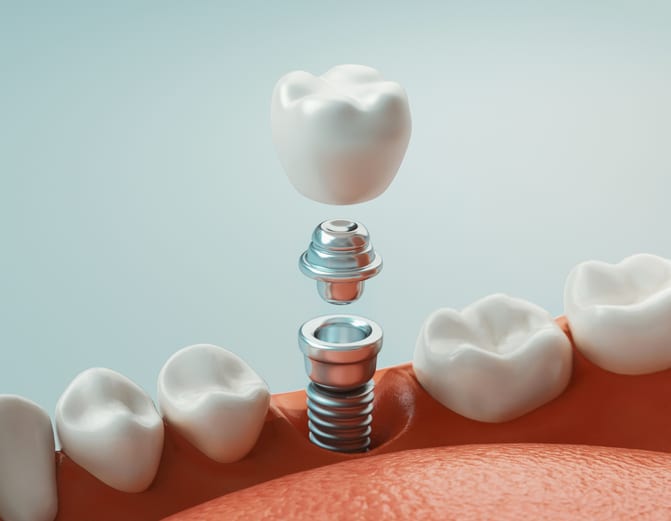 Dental Implants Viera, FL