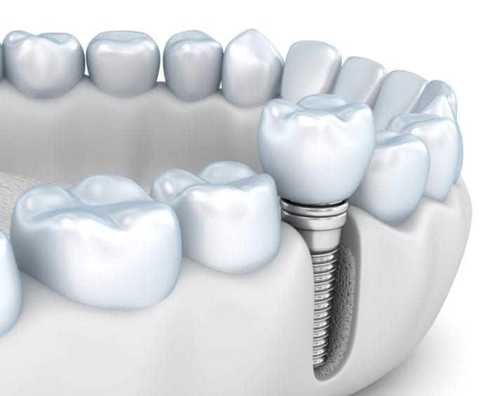 dental implants improve jawbone health in Rockledge Florida
