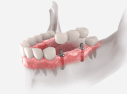 3d render of implant-supported dental bridge dental bridges dentist in Viera Florida
