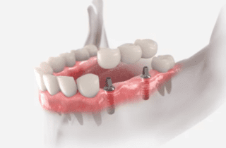 3d render of implant-supported dental bridge dental bridges dentist in Viera Florida