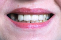 Closeup of smile with missing teeth restorative dentistry dentist in Viera Florida