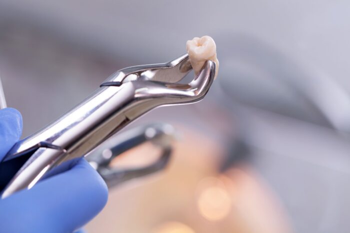 Why a Tooth Extraction