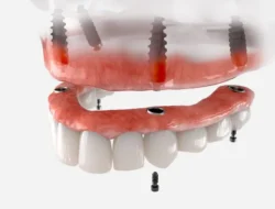Dentures vs. Implants: Which to Choose? in Rockledge, FL