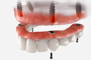 Dentures vs. Implants: Which to Choose? in Rockledge, FL